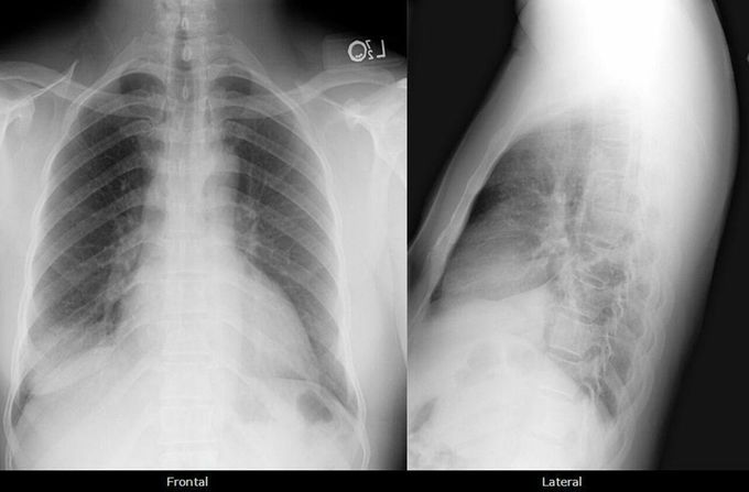 Right lower lobe consolidation, Cardiomegaly Findings: A - MEDizzy