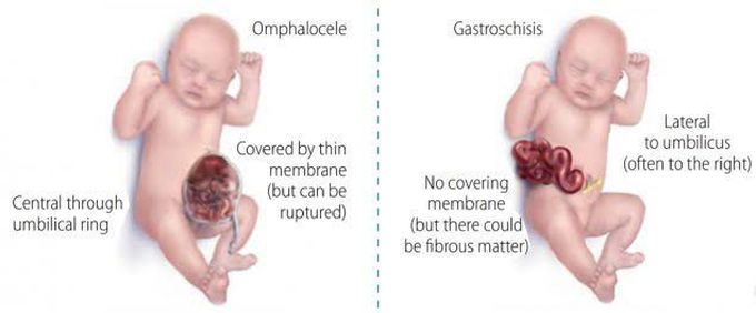 Omphalocele and Gastroschisis