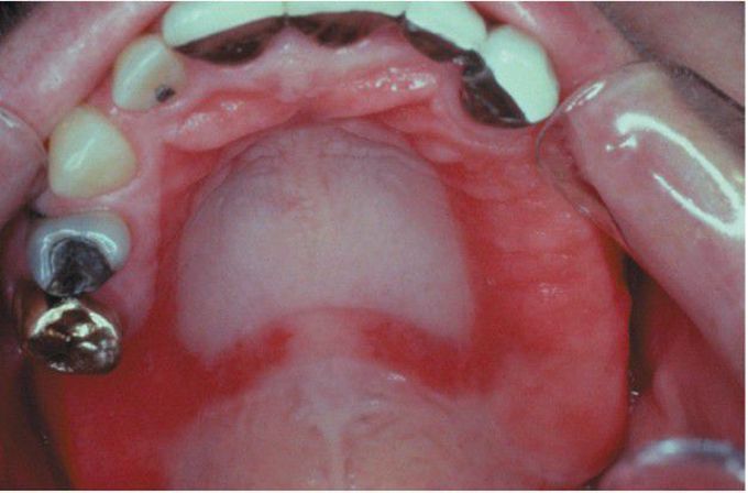 Denture Stomatitis