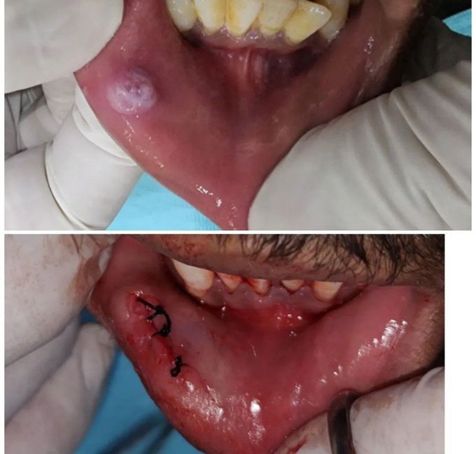 Mucocele Removal