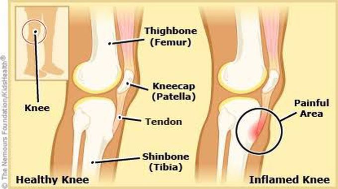 Osgood Schlatter Disease