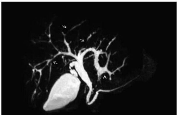 Picture showing MRCP (arrow marks )👩🏻‍⚕️🦄