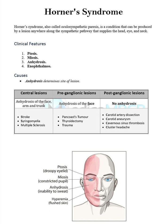 Horner Syndrome