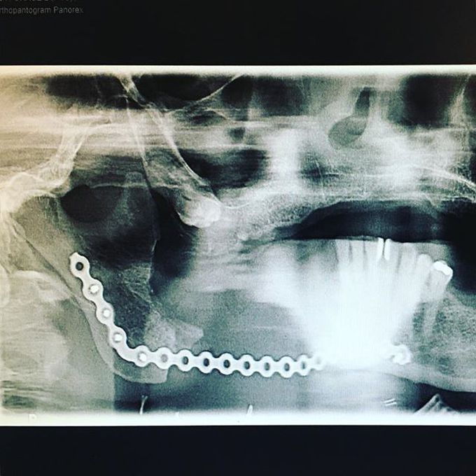 Partial resection of the mandible due to osteomyelitis Part II 👨‍⚕️⚙️🔨 