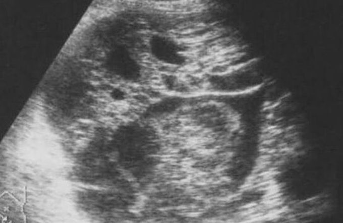 Phyllod carcinoma