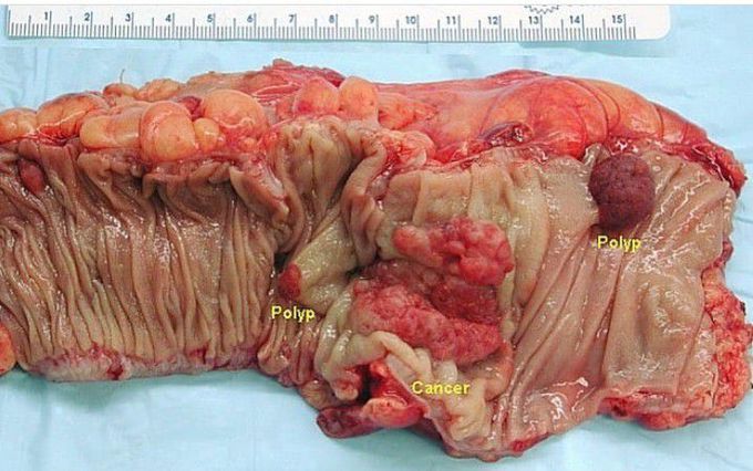 A Colectomy Specimen with Colorectal carcinoma and Adenomatous polyps