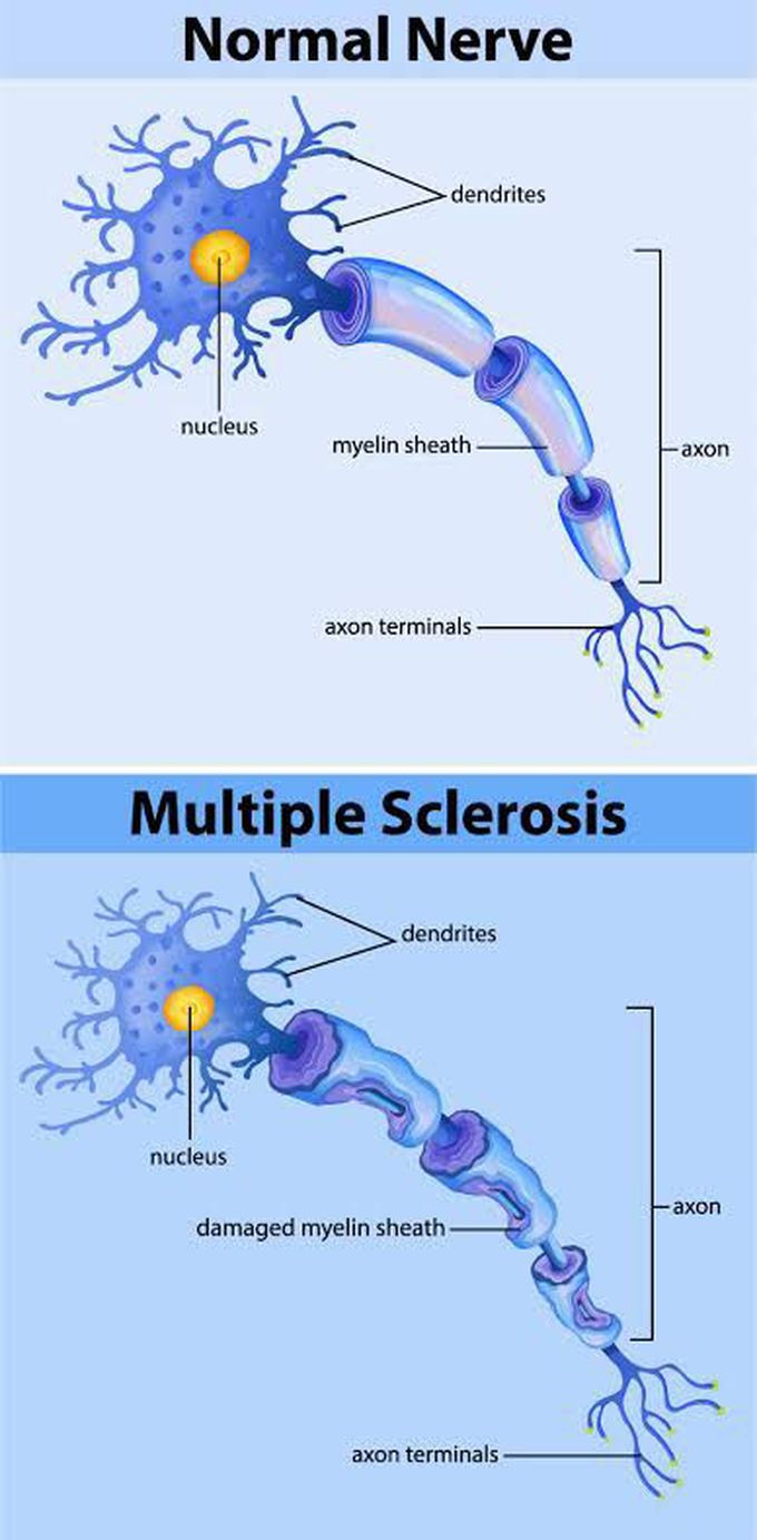 Multiple sclerosis