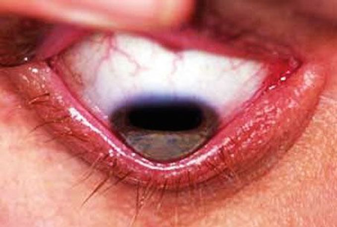 Keratoconus