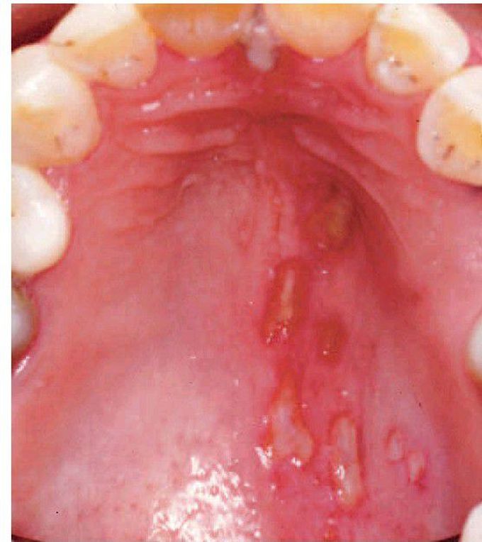 Herpes zoster infection