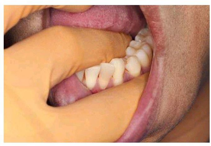 Extraction of mandibular left posterior teeth