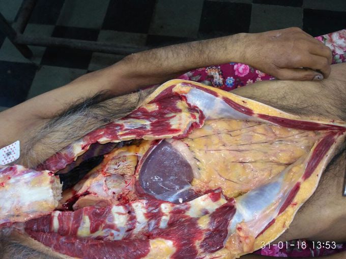 Autopsy