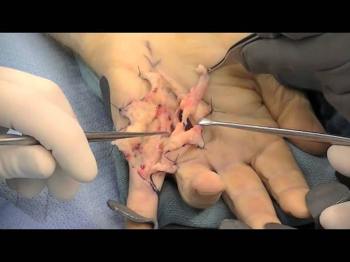 Dupuytren's Contracture Release