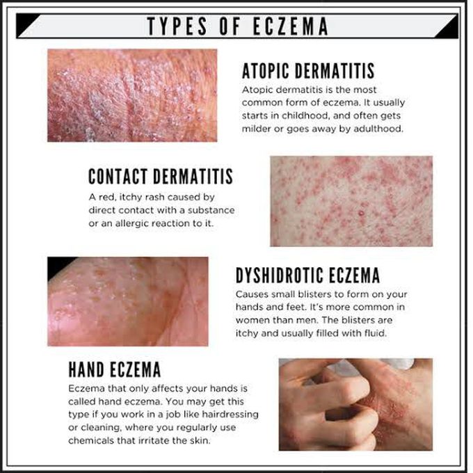 Types of Eczema