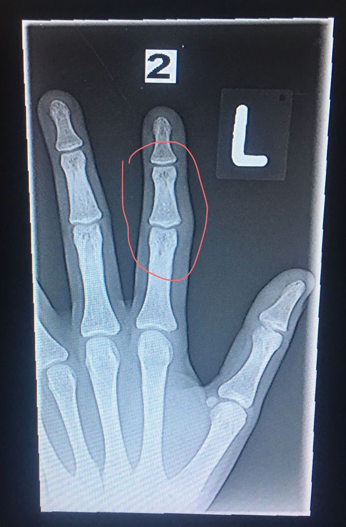 Broken finger?