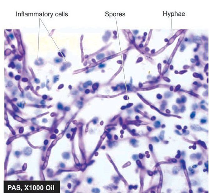 Candidiasis