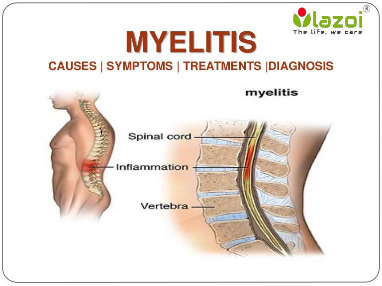 Миелит это. Миелит спинного мозга. Поперечный миелит спинного мозга мрт. Острый поперечный миелит. Инфекционный миелит.