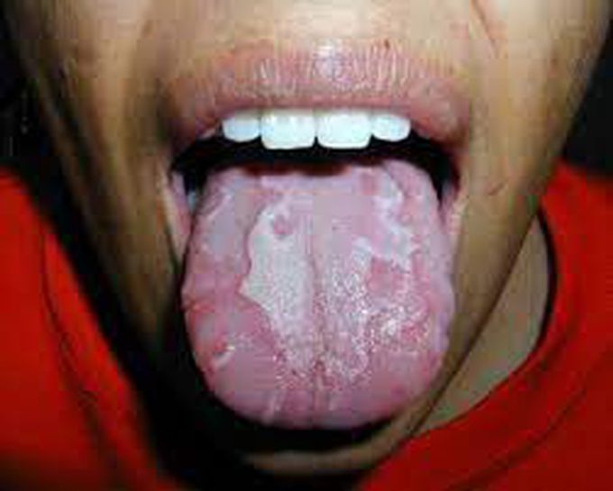 Symptoms of burning mouth syndrome