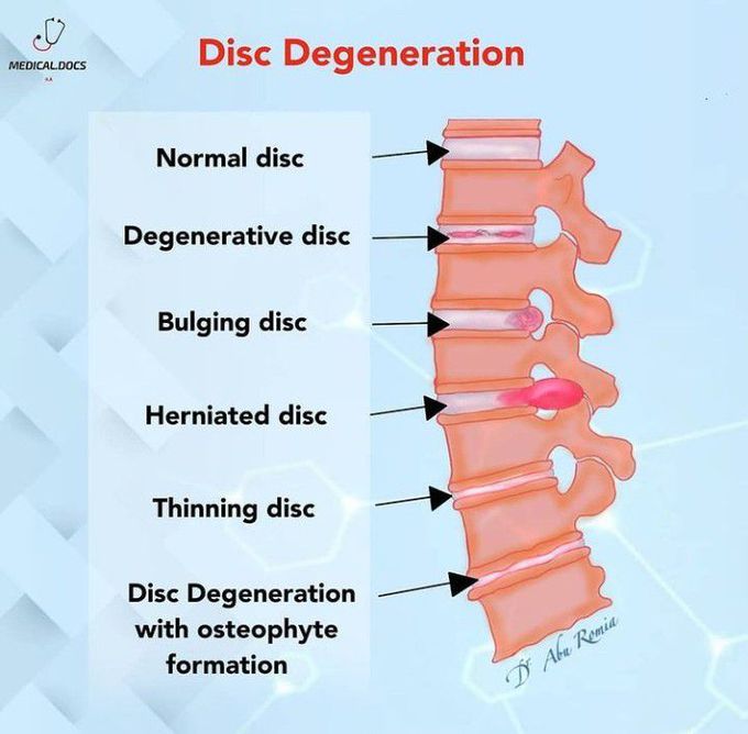 Disc Degeneration