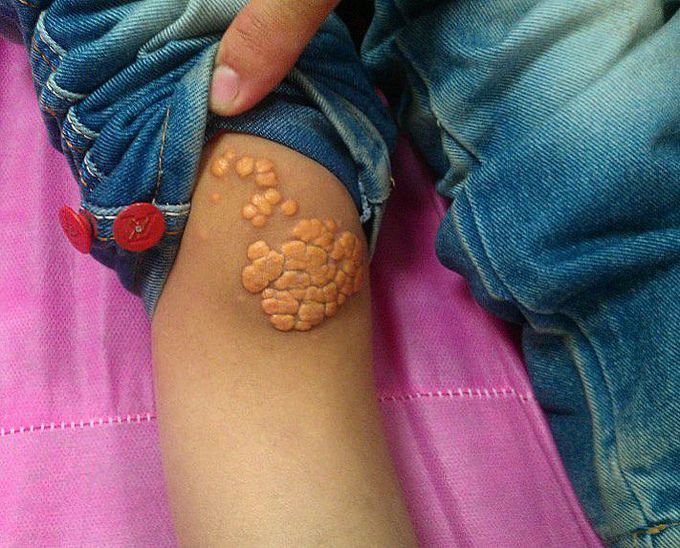 Multiple xanthoma tuberosum!!