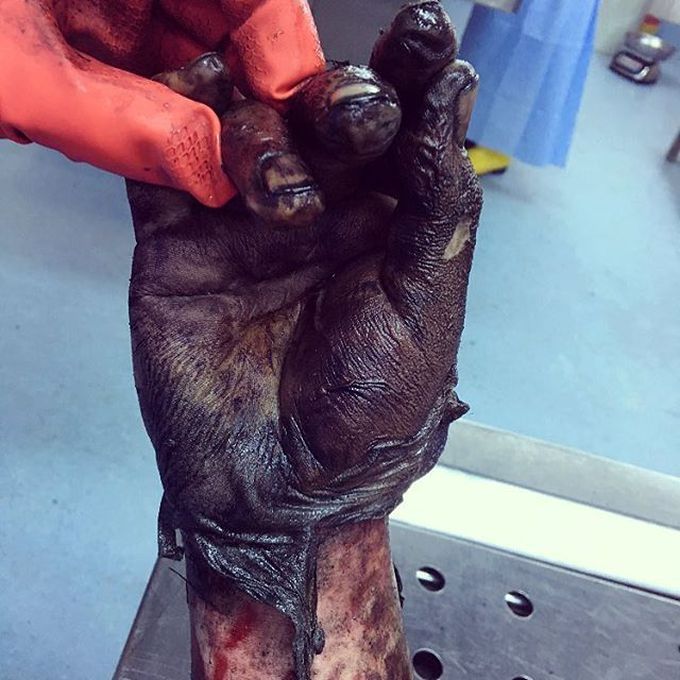 Burn injuries as a result of an electrical explosion!