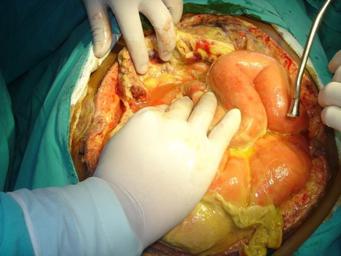 Clinical Features of Peritonitis