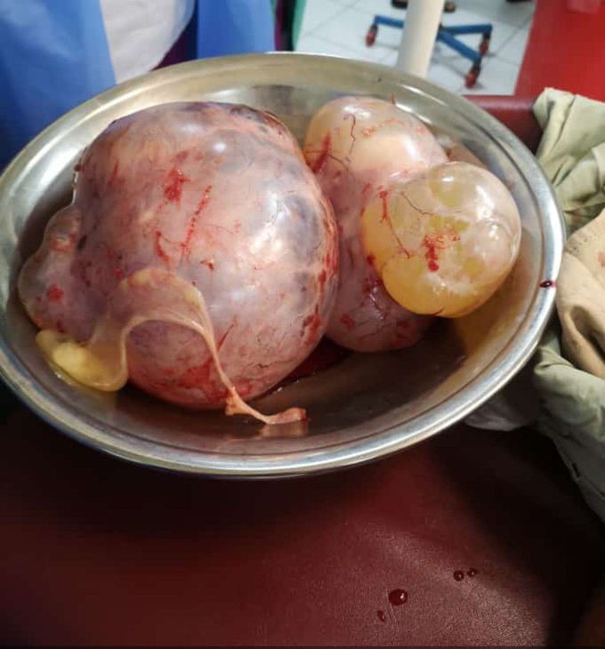 Ovarian cysts