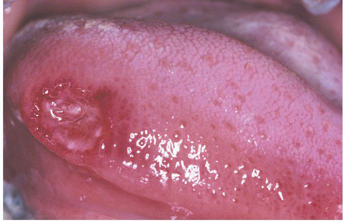 Cyclic Neutropenia