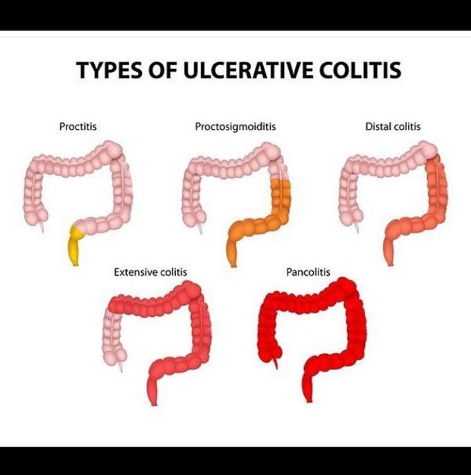 Ulcerative colitis 🙀