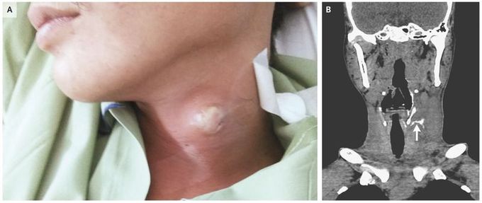 Branchial-Cleft Sinus Manifesting as Recurrent Neck Abscess