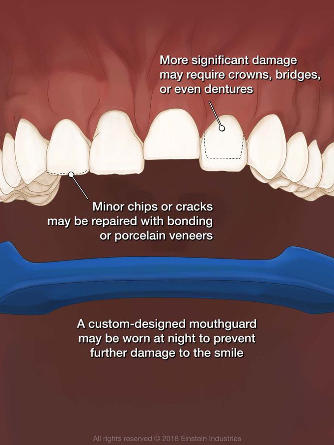 What causes teeth grinding?