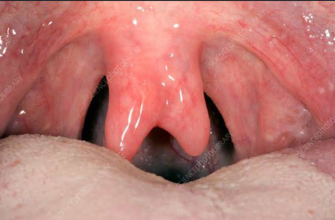 Bifid uvula