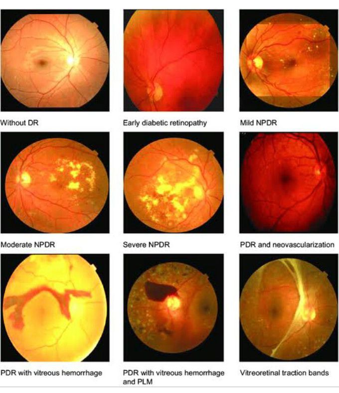 Stages of Diabetic Retinopathy