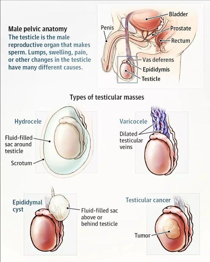 Types of testicular masses