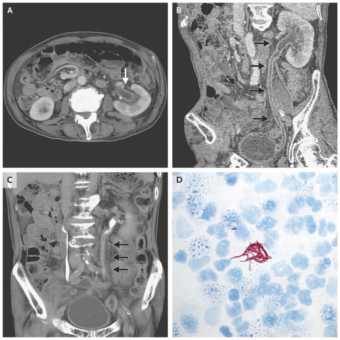 Urinary Tract Tuberculosis