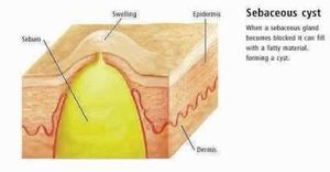 Sebaceous cysts - MEDizzy