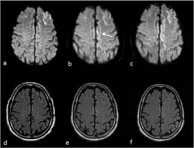 Creudtz feldt jakob disease