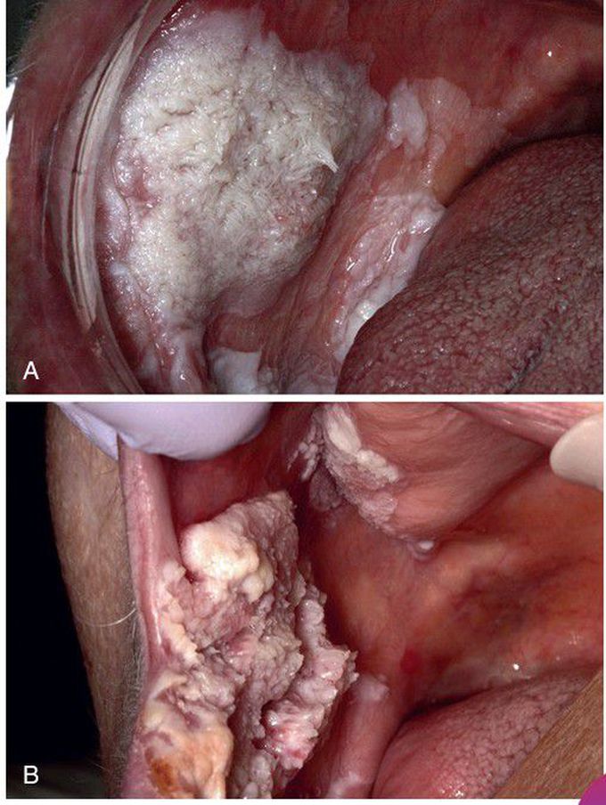 Proliferative Verrucous Leukoplakia (PVL).