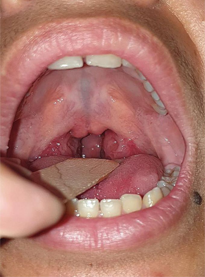 Submucosal Cleft Palate