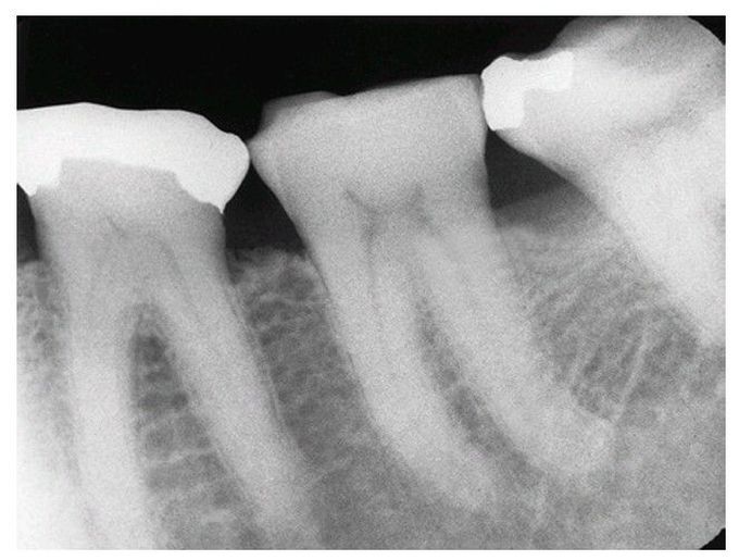 Bruxism