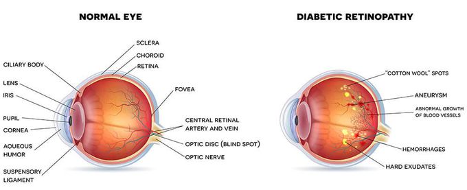 Diabetic retinopathy
