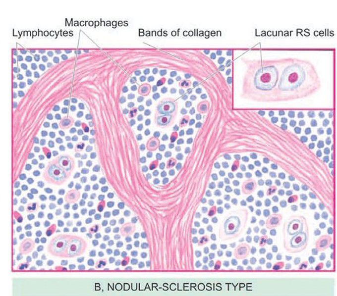 Nodular sclerosis type (hodgekin's lymphoma)