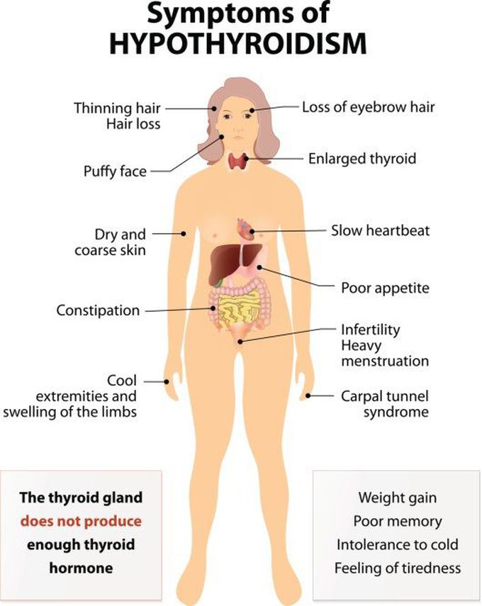 Symptoms of hypothyroidism