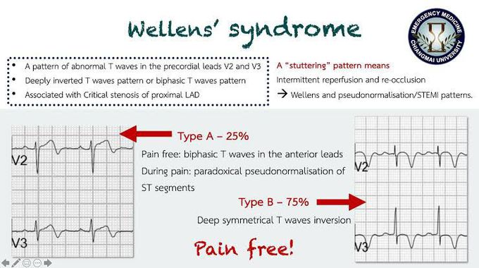 Wellen's Syndrome