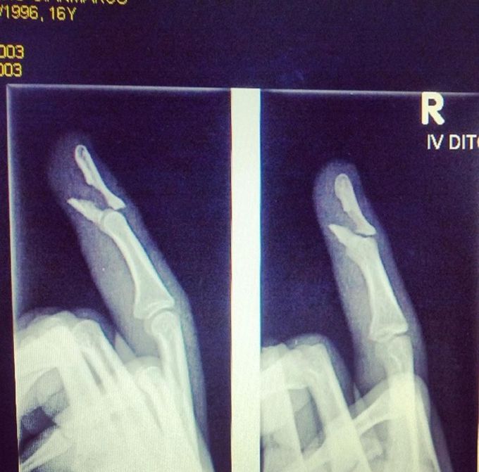 4th finger fracture