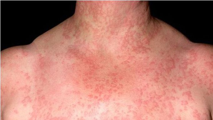 Water allergy