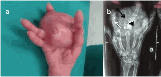 Chondrosarcoma: A Bony Cancer