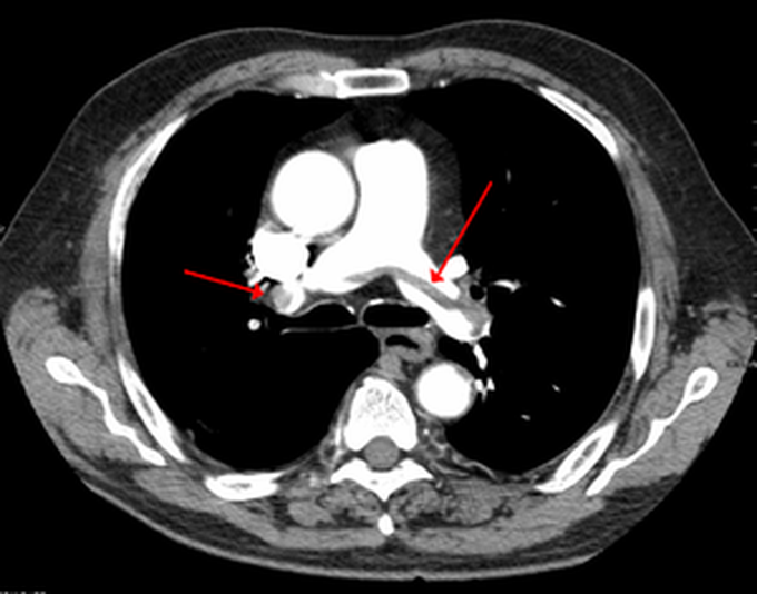 Pulmonary embolism