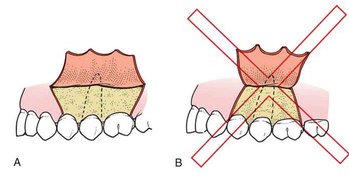 Principles of flap design