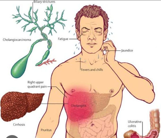 Symptoms of Cholangitis