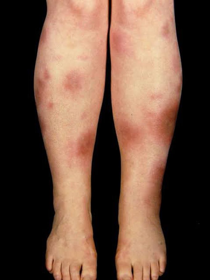 Erythema Nodosum